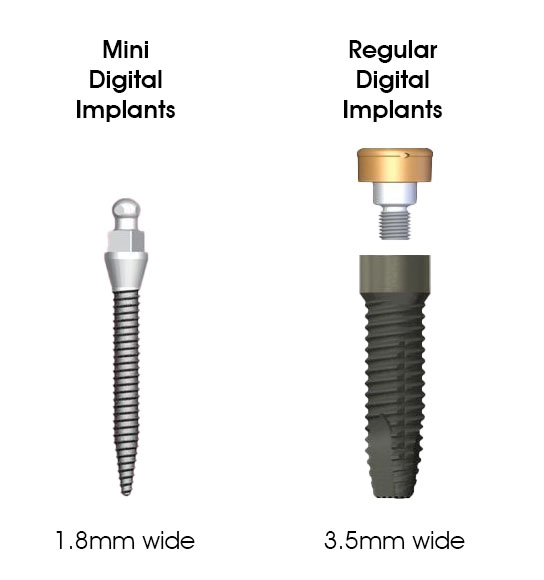 dental implants sunshine coast - traditional vs mini implants