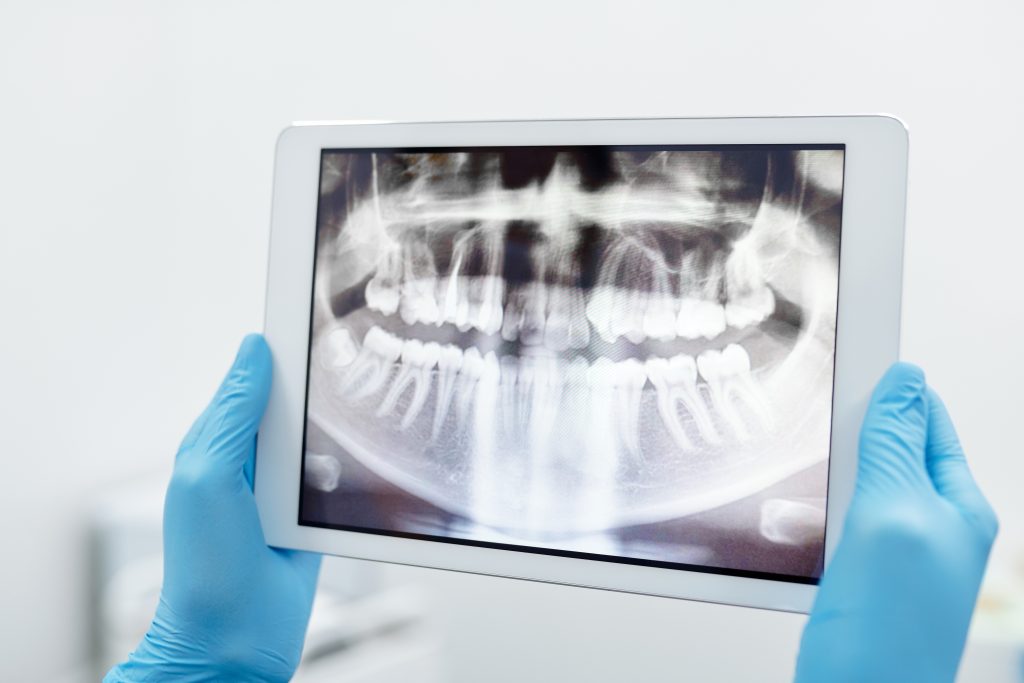 tooth extractions - xray on ipad