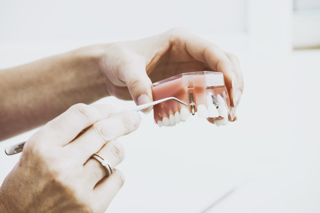 dental implants - hand and fake teeth