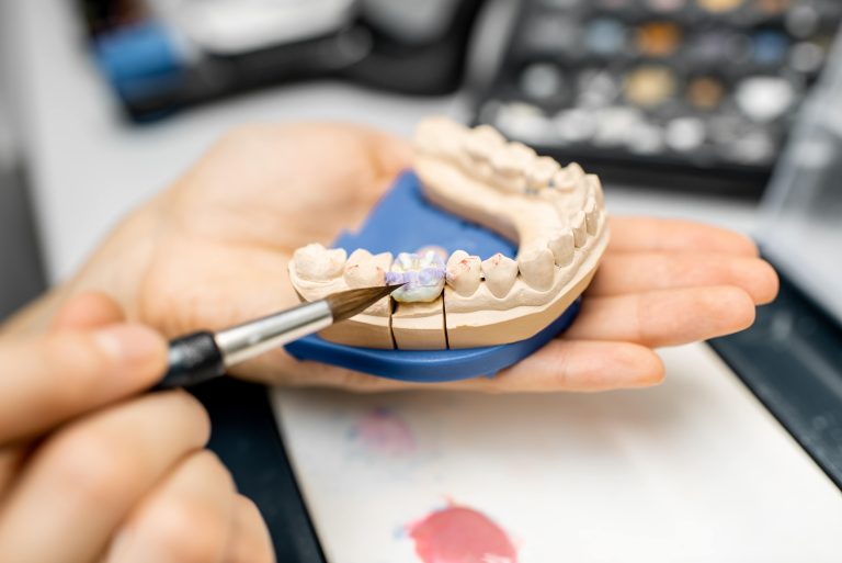 dental implants - tooth model